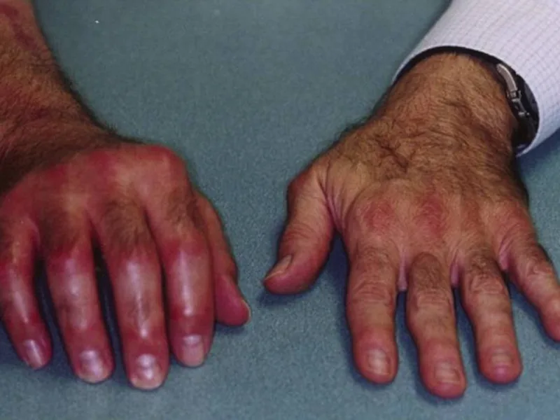 Close-up of two hands with red, swollen, inflamed skin