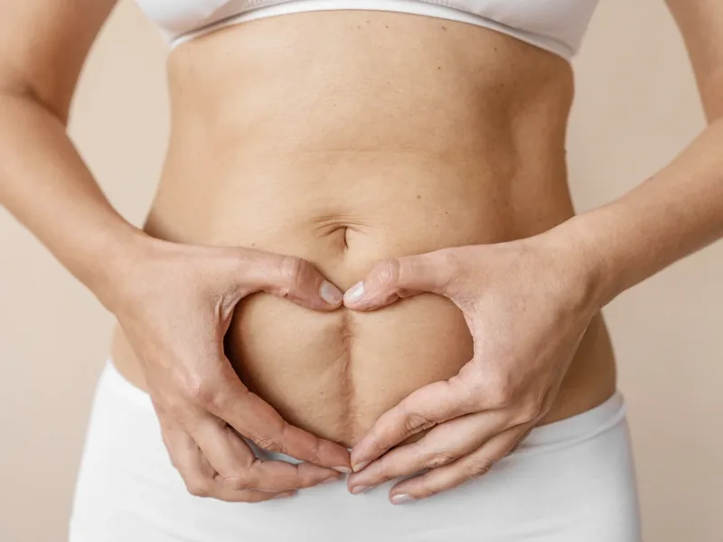 A postpartum abdomen with both hands framing the midline of the belly
