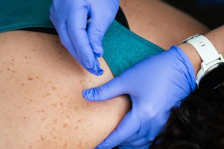 Gloved hands performing dry needling on a patient's upper back at Motion Matters