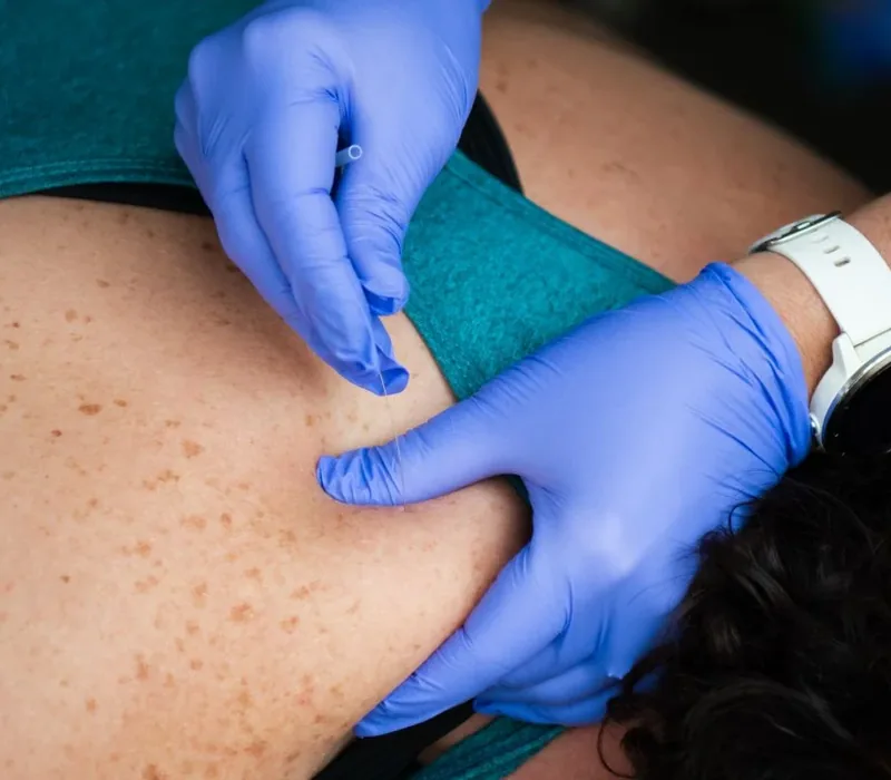 Gloved hands placing a dry needling needle into a patient's upper back at Motion Matters