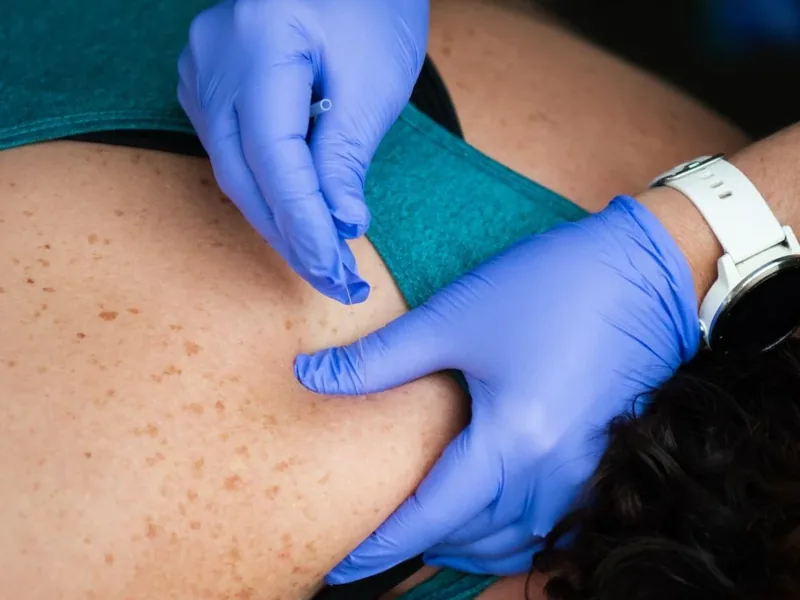 Gloved hands placing a dry needling needle into a patient&rsquo;s upper back at Motion Matters
