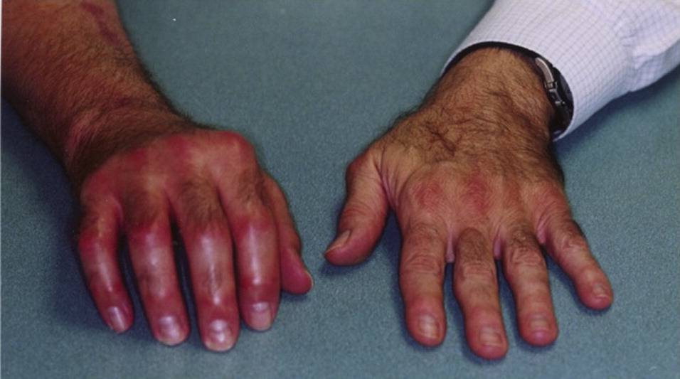 crps